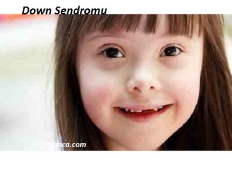 Down Sendromu Nedir?